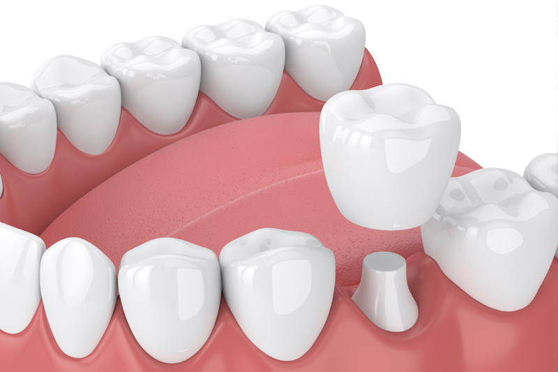 Dental Crowns in El Paso